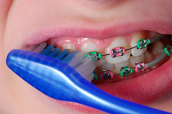 Cleaning Braces