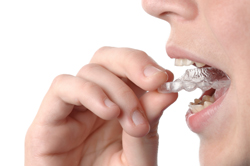 Putting in Retainer