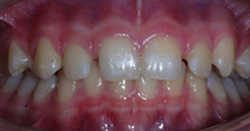 Orthodontic Treatment - Before