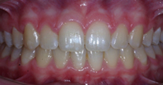Orthodontic Treatment - After