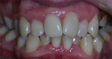 Orthodontic Treatment - Before