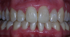 Orthodontic Treatment - After